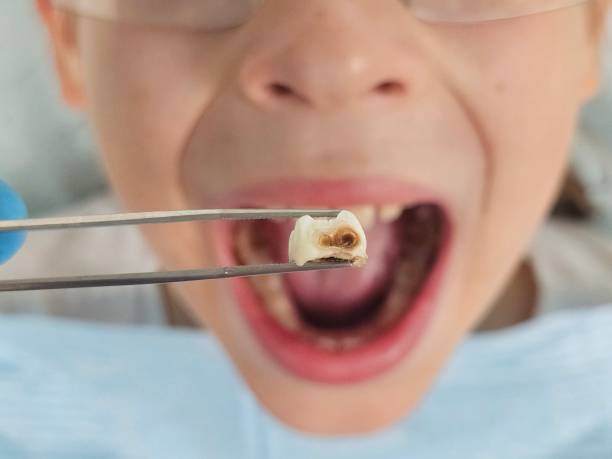 Best Emergency Wisdom Teeth Removal in Carbonville, UT